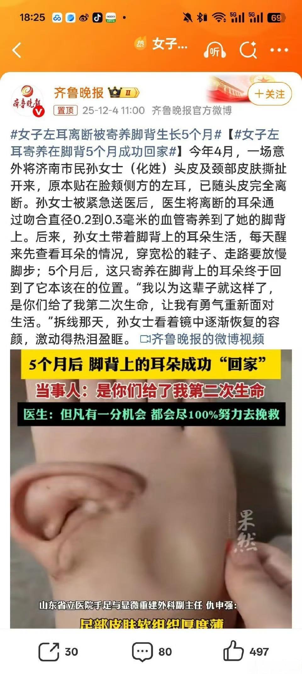 女子左耳“寄养”脚背5个月终归位！医生妙手完成高难度移植，背后故事太揪心
 
2