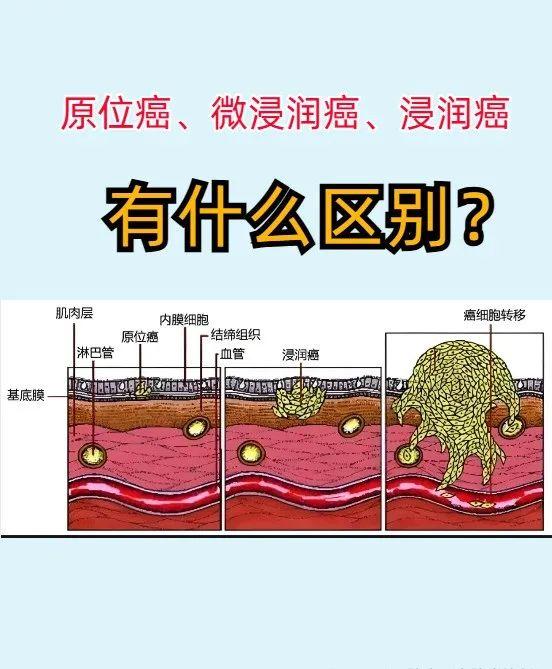 同样都是癌症，原位癌、微浸润癌、浸润癌，有什么区别？别再傻乎乎的不知道了！