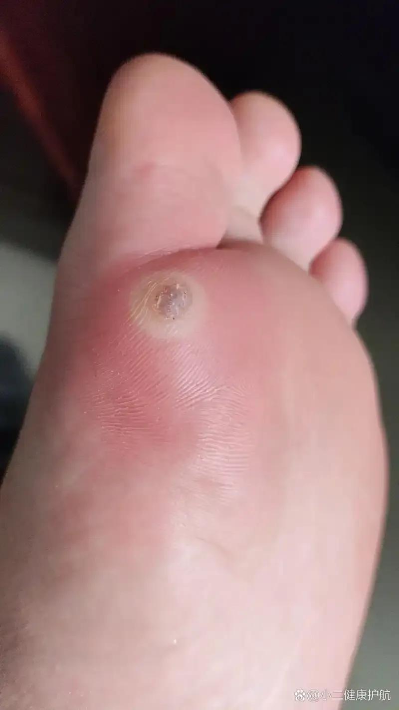 有没有人长过趾疣趾疣？这种病真的很恶心，因为它不疼也不痒，对我们生活也造不成影响