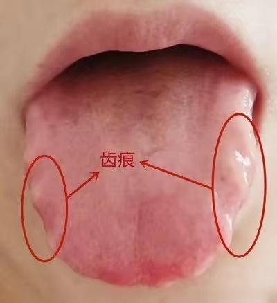 舌边齿痕，湿气横行，几个中成药助你踏平一身湿气有的齿痕舌并非脾虚湿气重所引起，虽