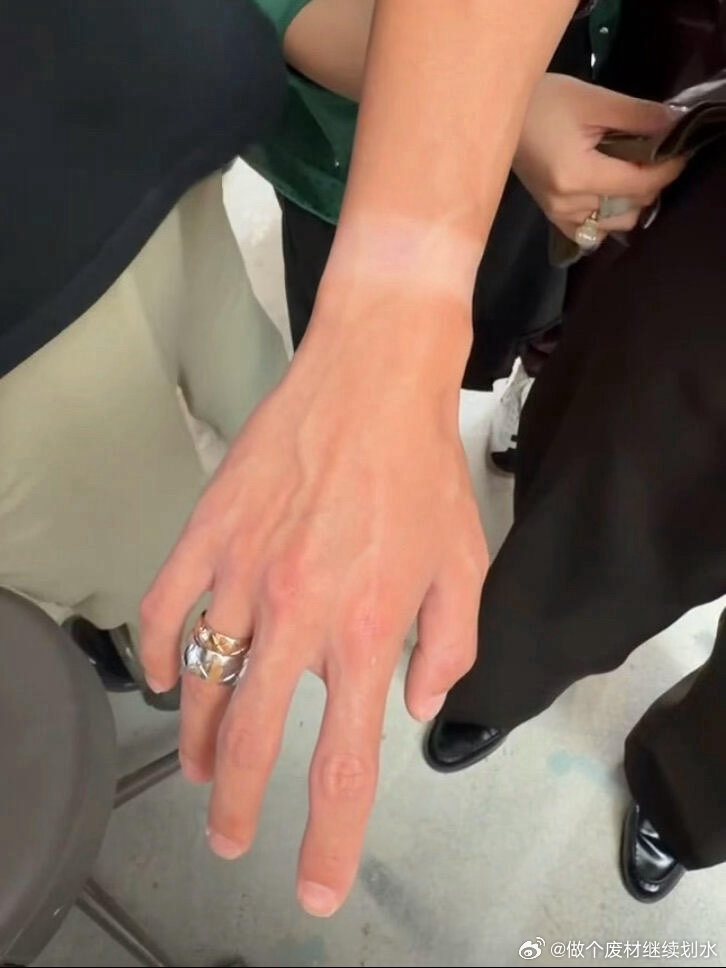王一博手腕晒分层了王一博做一下防晒吧 王一博哥真的是要做一下防晒了啊！这个手腕都