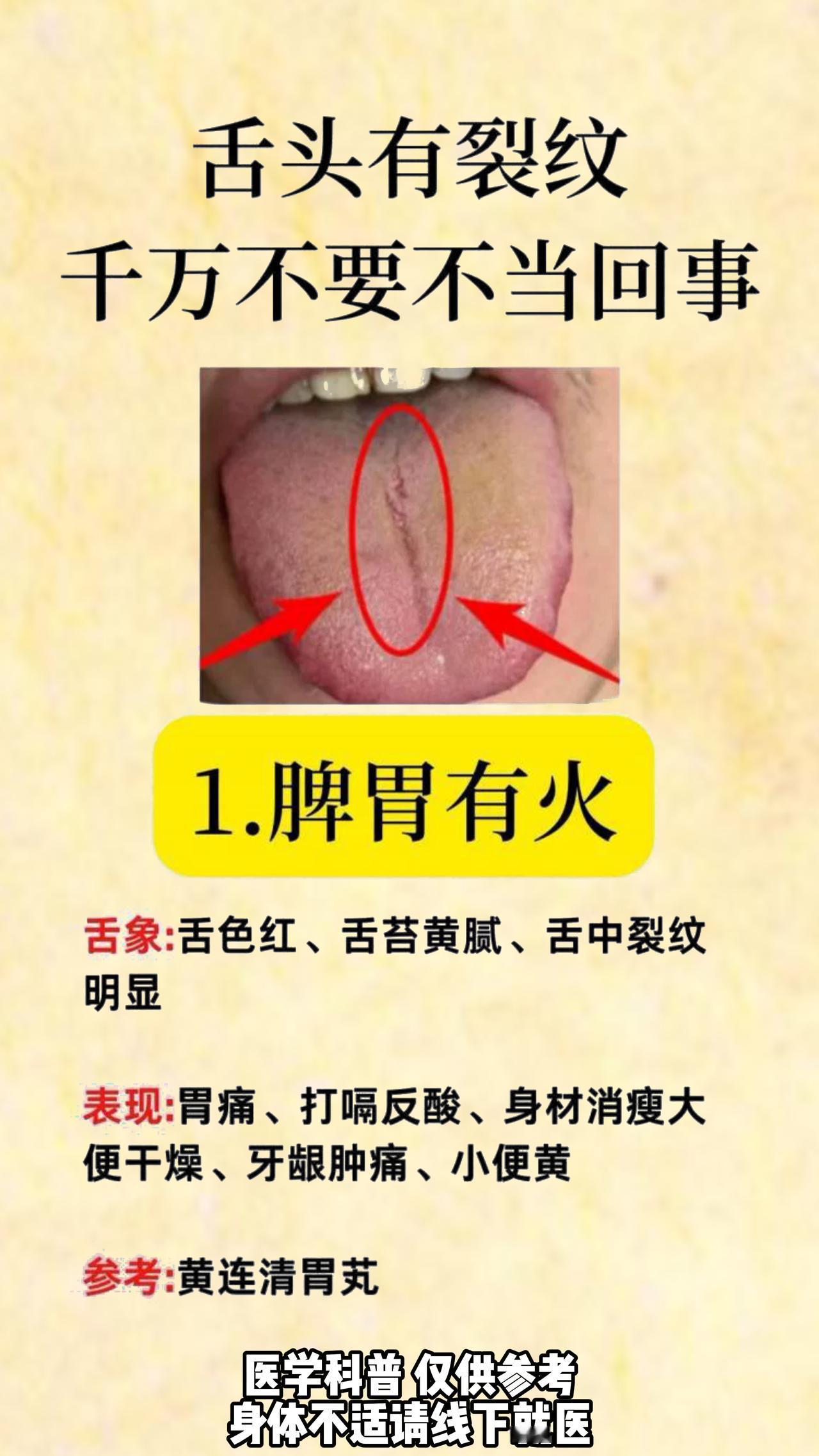 舌头有裂纹 千万不要不当回事#中医##健康#