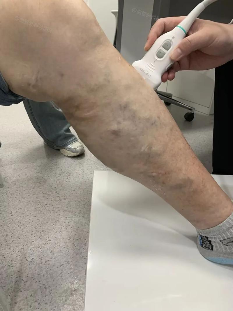 隔壁小区一位大爷就是活生生的例子，腿上青筋凸起几十年一直不愿就医，总说人老了有点