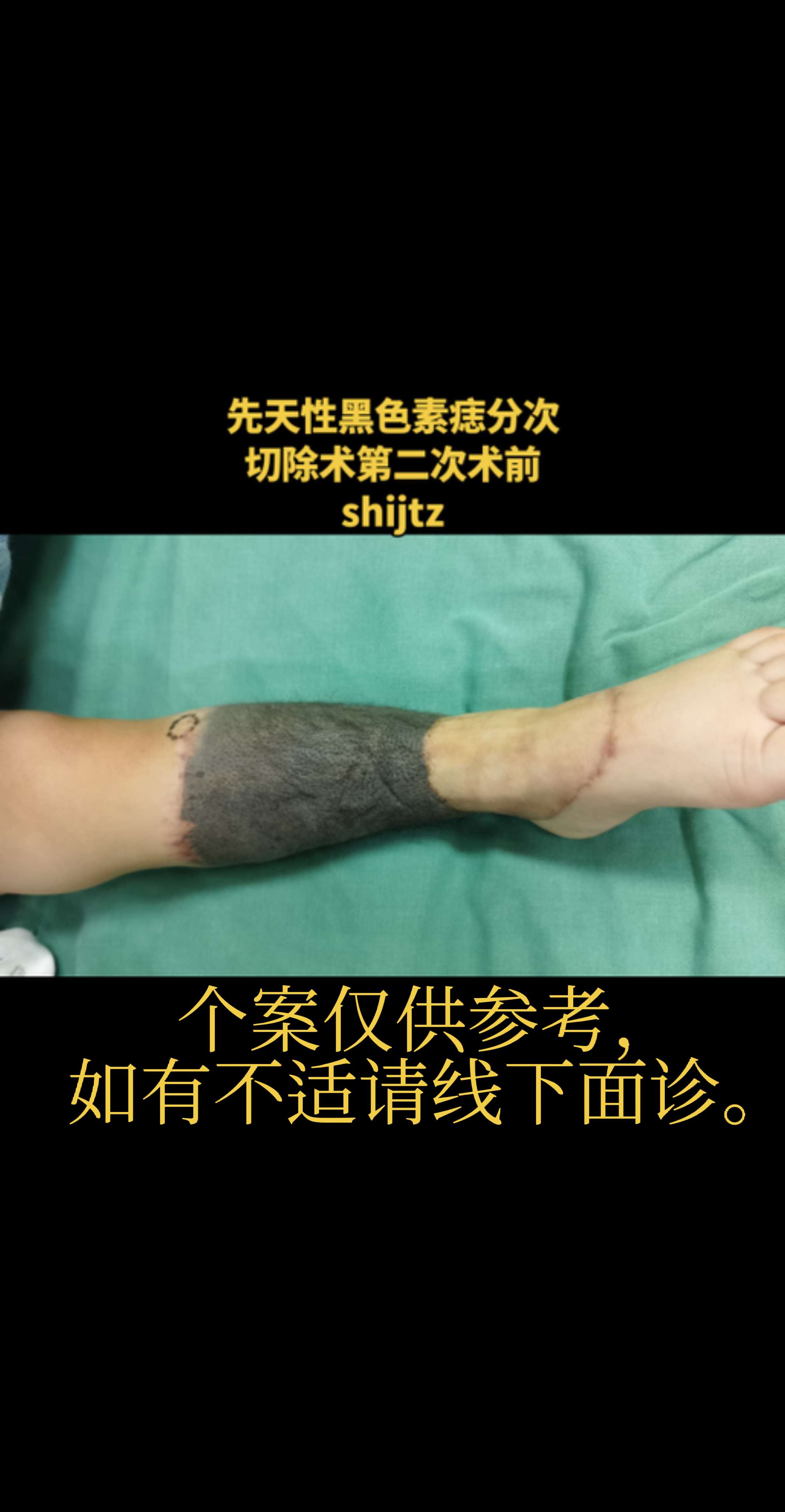 巨痣。先天性黑色素痣分次切除术第二次术前。