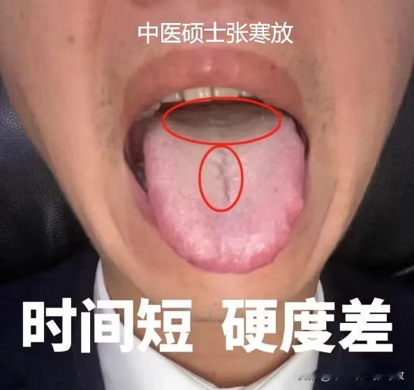 一旦出现这种舌头，你就别再吃六味地黄了[吃瓜群众][吃瓜群众][吃瓜群众]
六味