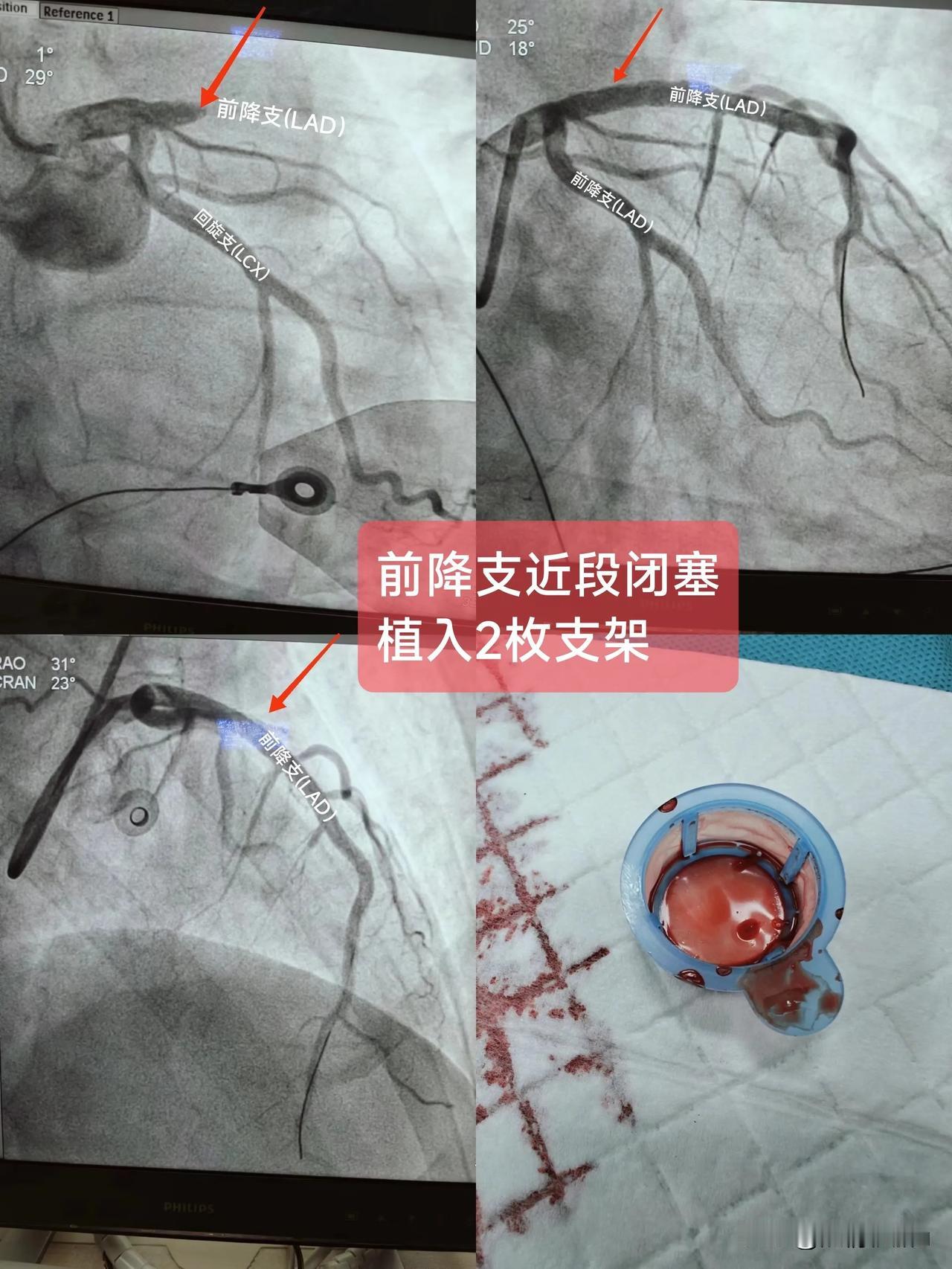 急性ST段抬型心肌梗死
(前降支近段闭塞)

一.概念：
前降支主要为前壁及前间