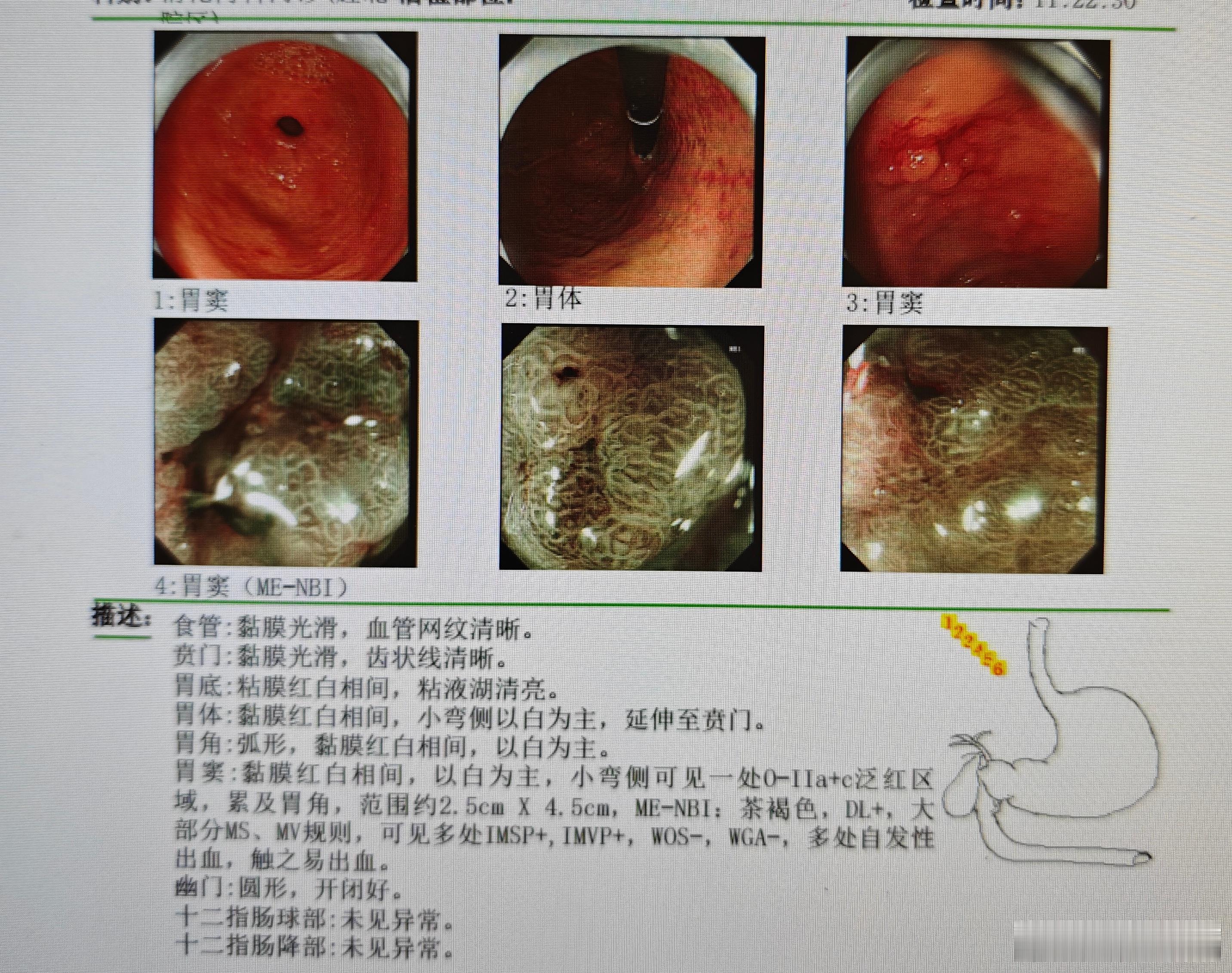 这例最后病理是癌变，中高分化，看来这个精查的技能还有待提高，不能止步于发现病变，