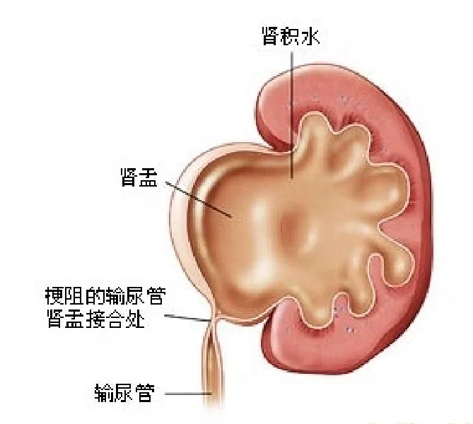 肾积水/肾盂分离 不一定是小问题！