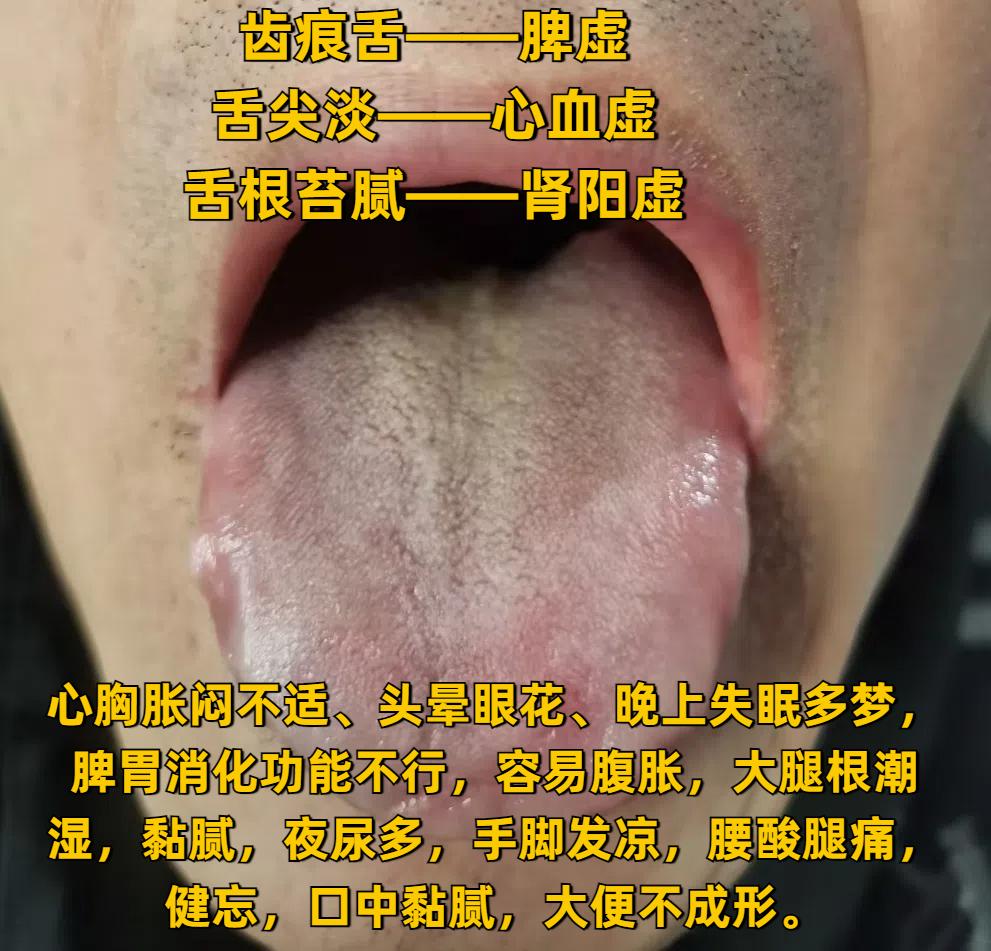 这会儿不忙，抽空帮大家继续看舌象，今天是第20天！

不管是心火旺、脾胃虚、肝郁