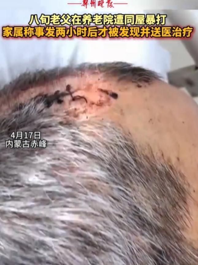 内蒙古赤峰，女子将丈夫送到养老院，几天后接丈夫，只见丈夫裤子直接裂开到裤裆，上衣