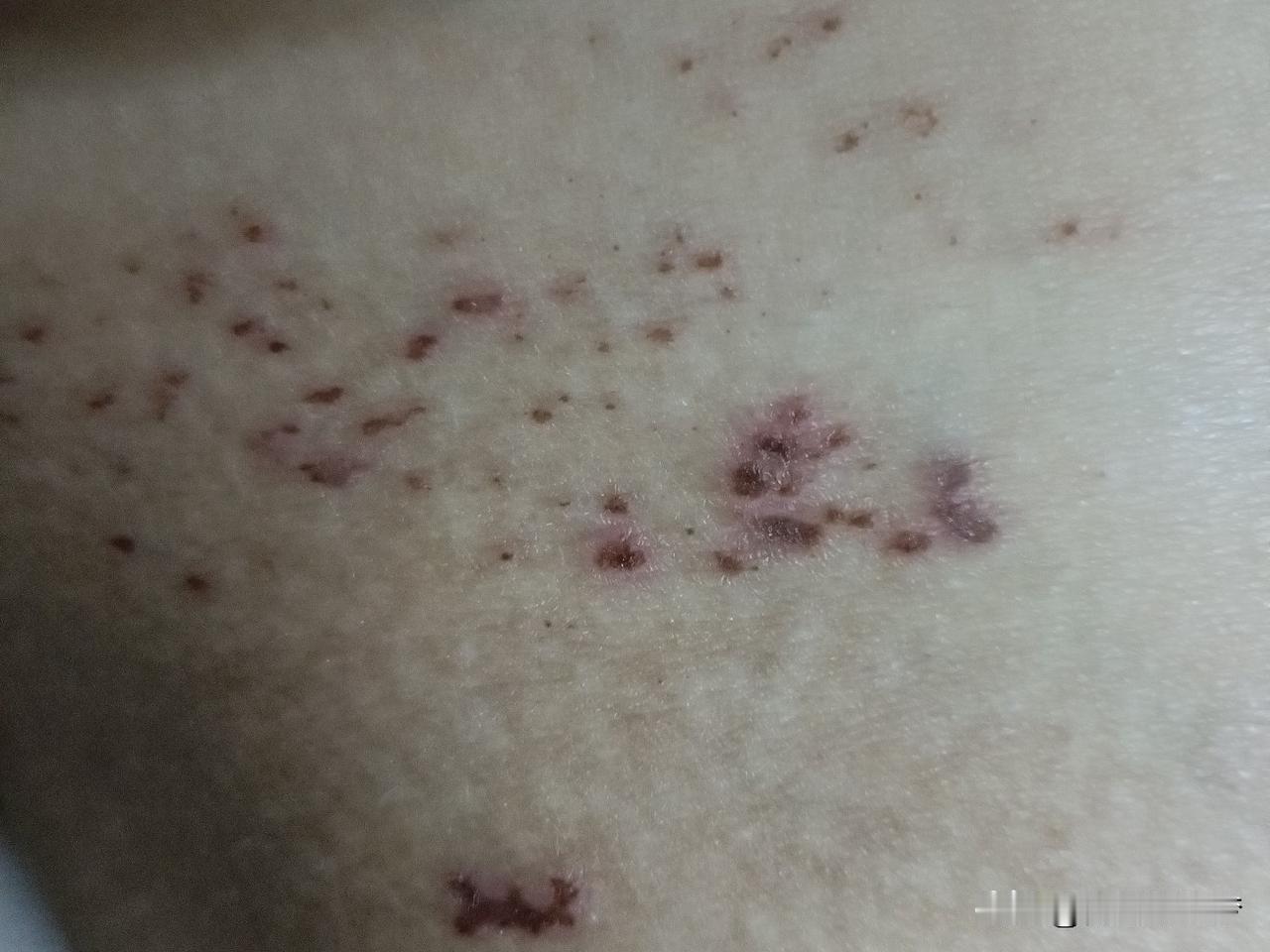 疱疹从发生到现在第7天

第二天晚上开始去看，开始挂针，吃药，擦药

到昨天挂了