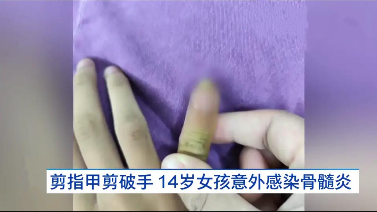 武汉一个14岁女孩自己在家剪指甲，手一抖剪破了右手小指，流点血，她拿纸巾按一按，
