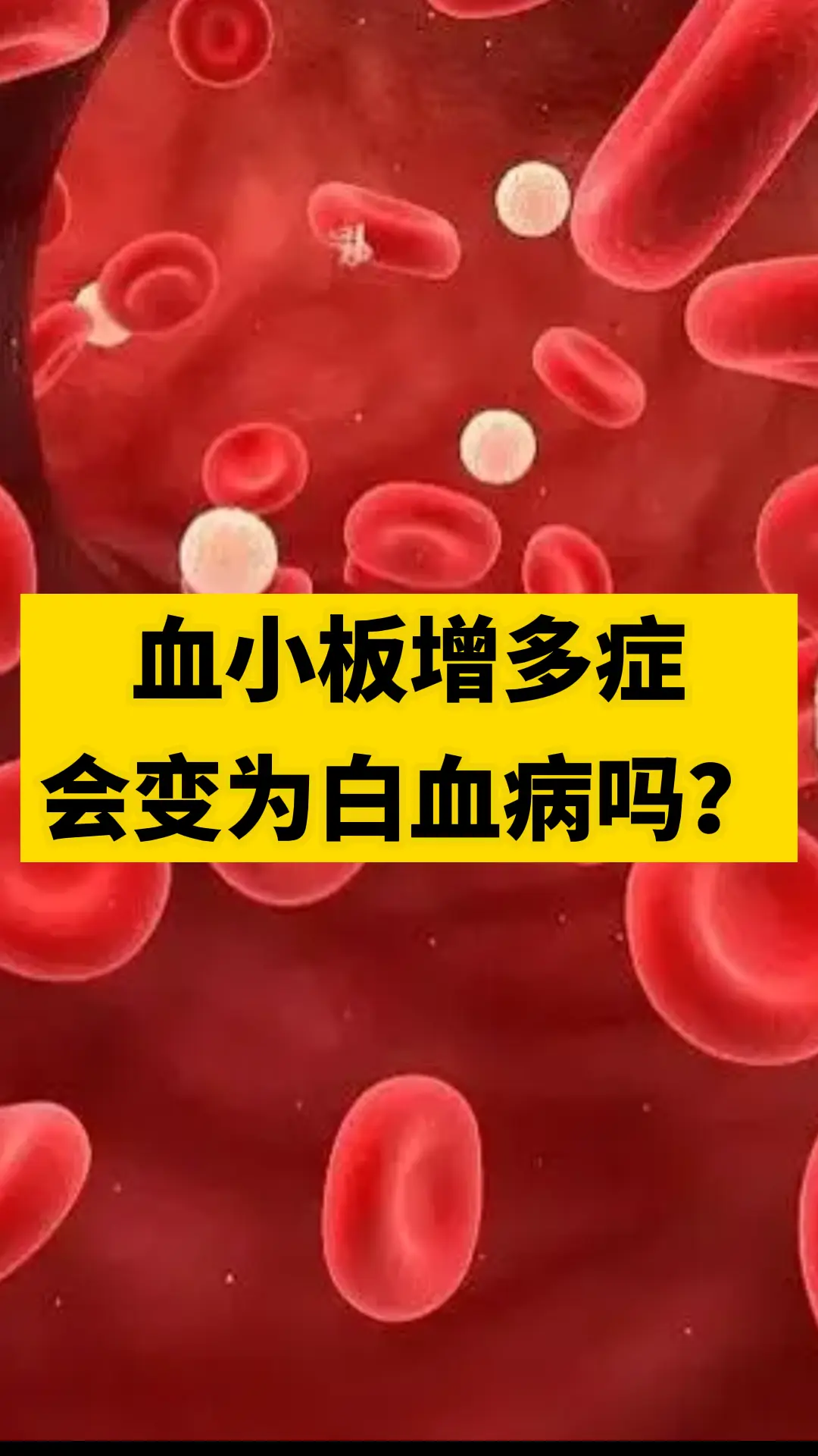 血小板增多症会转化成白血病吗？这一直是血小板增多患者最为担心的问题。 ...