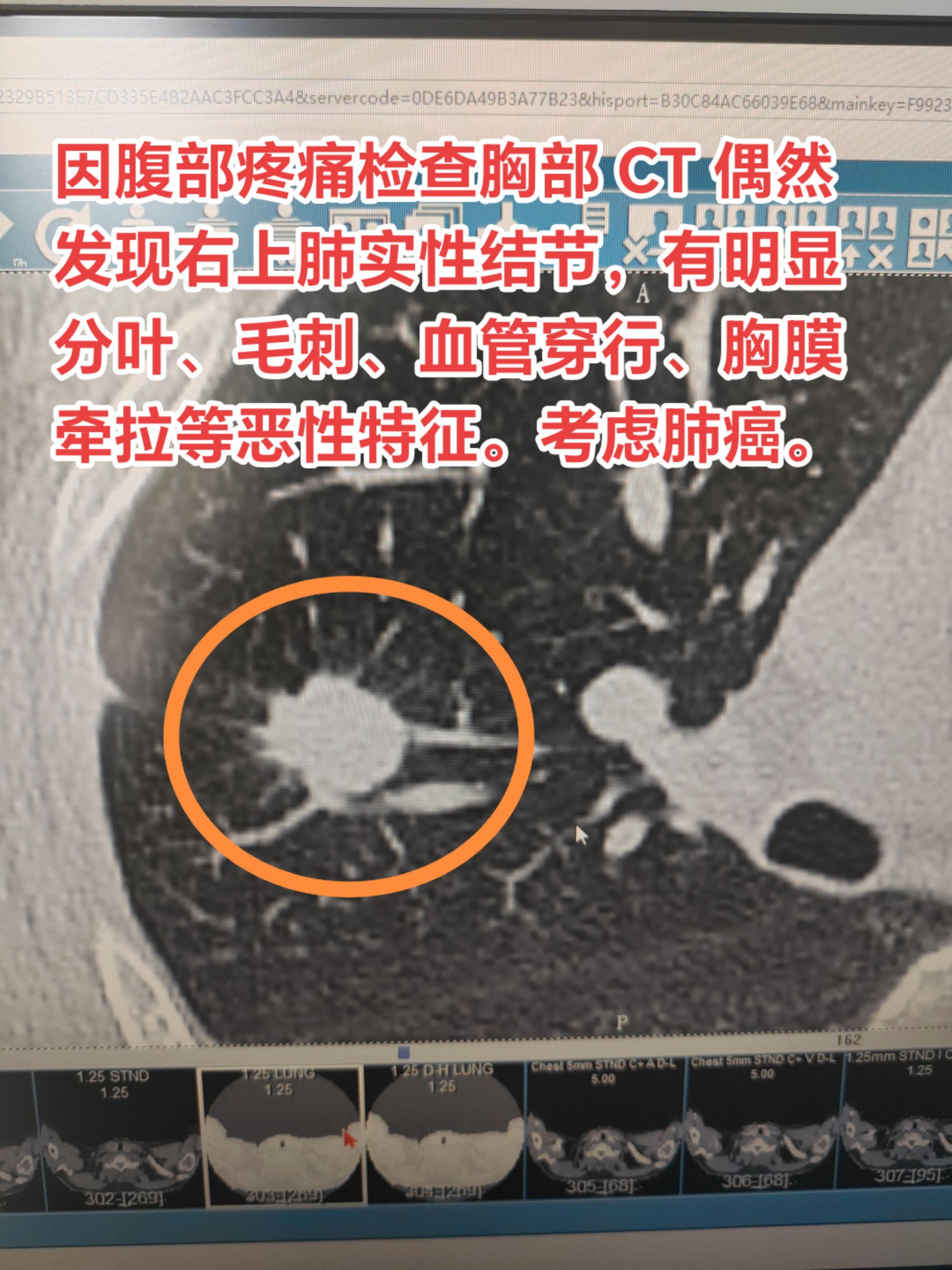肺结节常无咳痰咳痰、胸闷气短、胸痛等症状。因腹部疼痛（阑尾炎）检查胸部...
