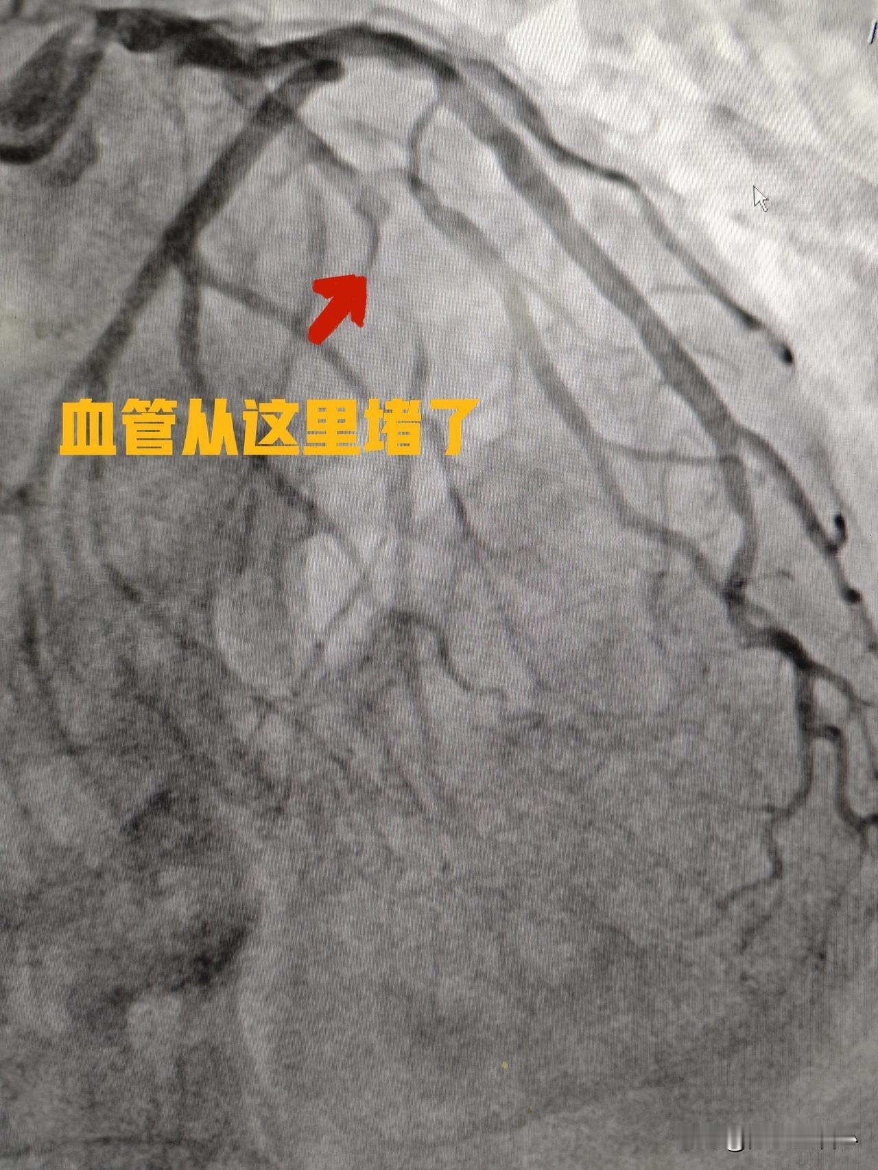表面看是慢性闭塞血管，实际是近期急性闭塞。今天上午做了一台手术，68 岁男性患者