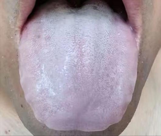 揭秘肾虚辨型秘诀！肾阳虚 / 阴虚 / 气虚，舌头早藏答案

①肾阳虚
舌象分析