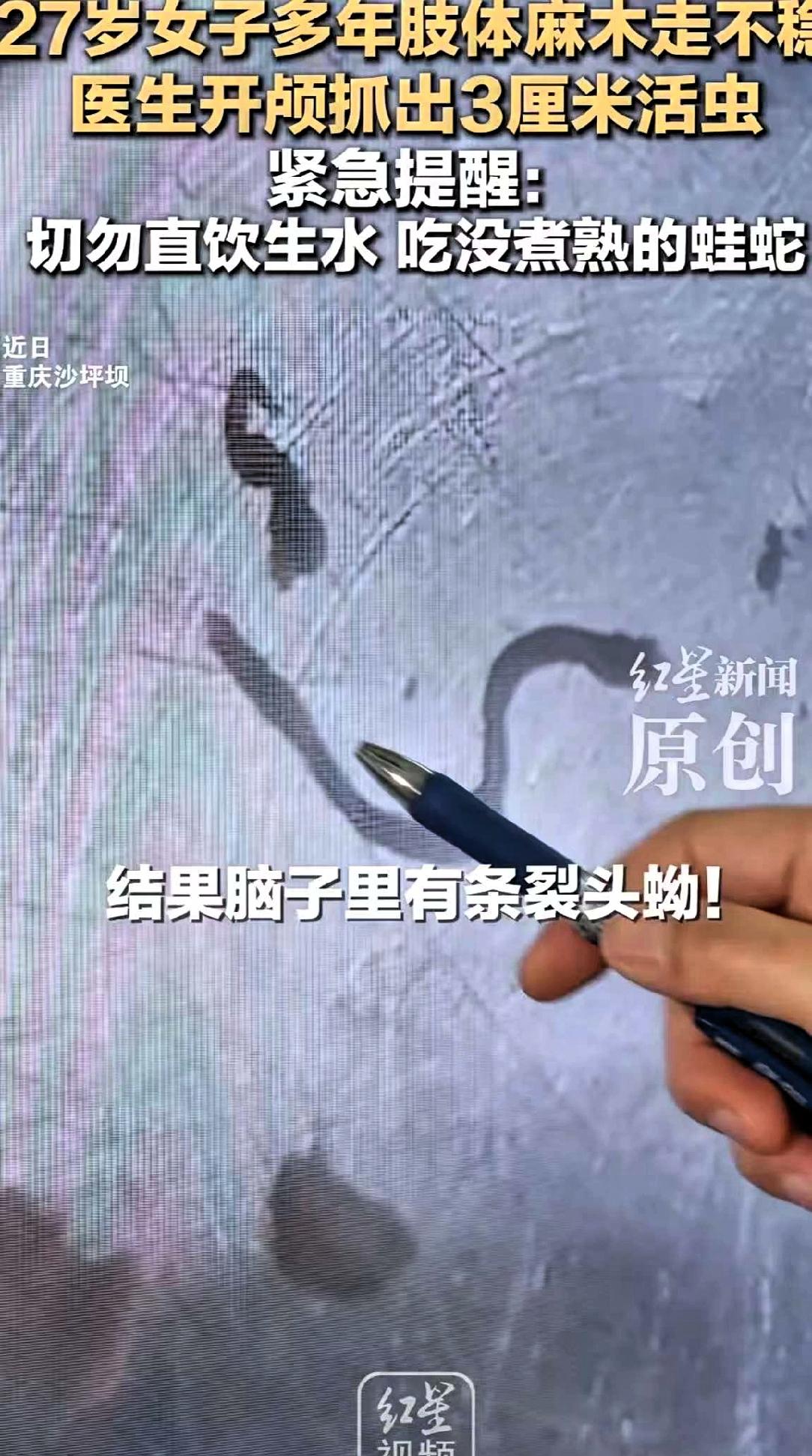 重庆一女子，头疼了5年。
跑遍大医院，医生都说可能是脑瘤。
结果开颅后，取出来的