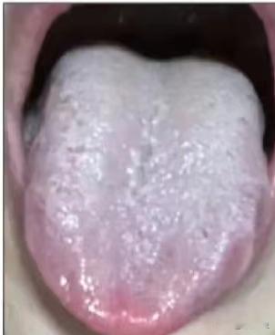 这样的舌头，不能用逍遥散，就算是肝郁的再严重也不行

主诉：总是胸闷、心慌，怕冷