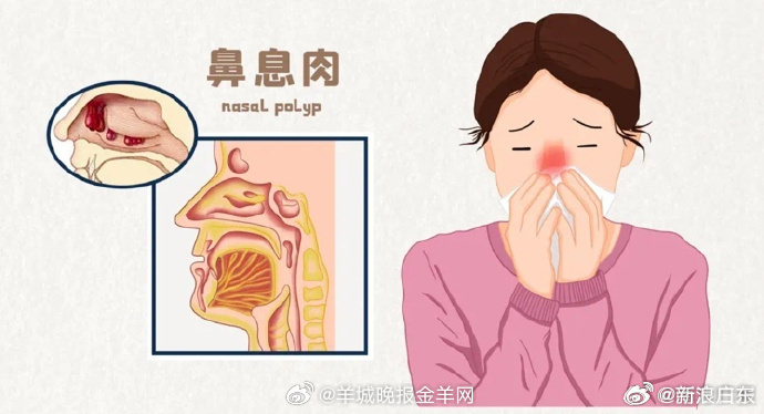【#苟伟死因系鼻息肉肥大致呼吸骤停#】#鼻息肉过大的4大危害#5月7日凌晨，歌手