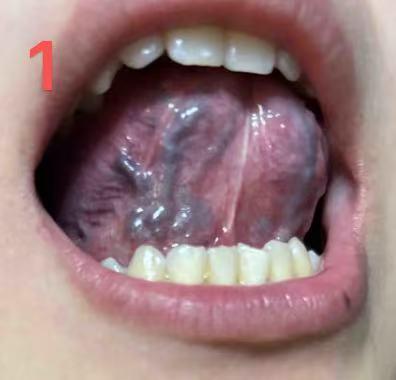 血瘀也分热脾气”和冷冰冰？中医：看舌头颜色！分清“气瘀”和“寒瘀”！

一、 气