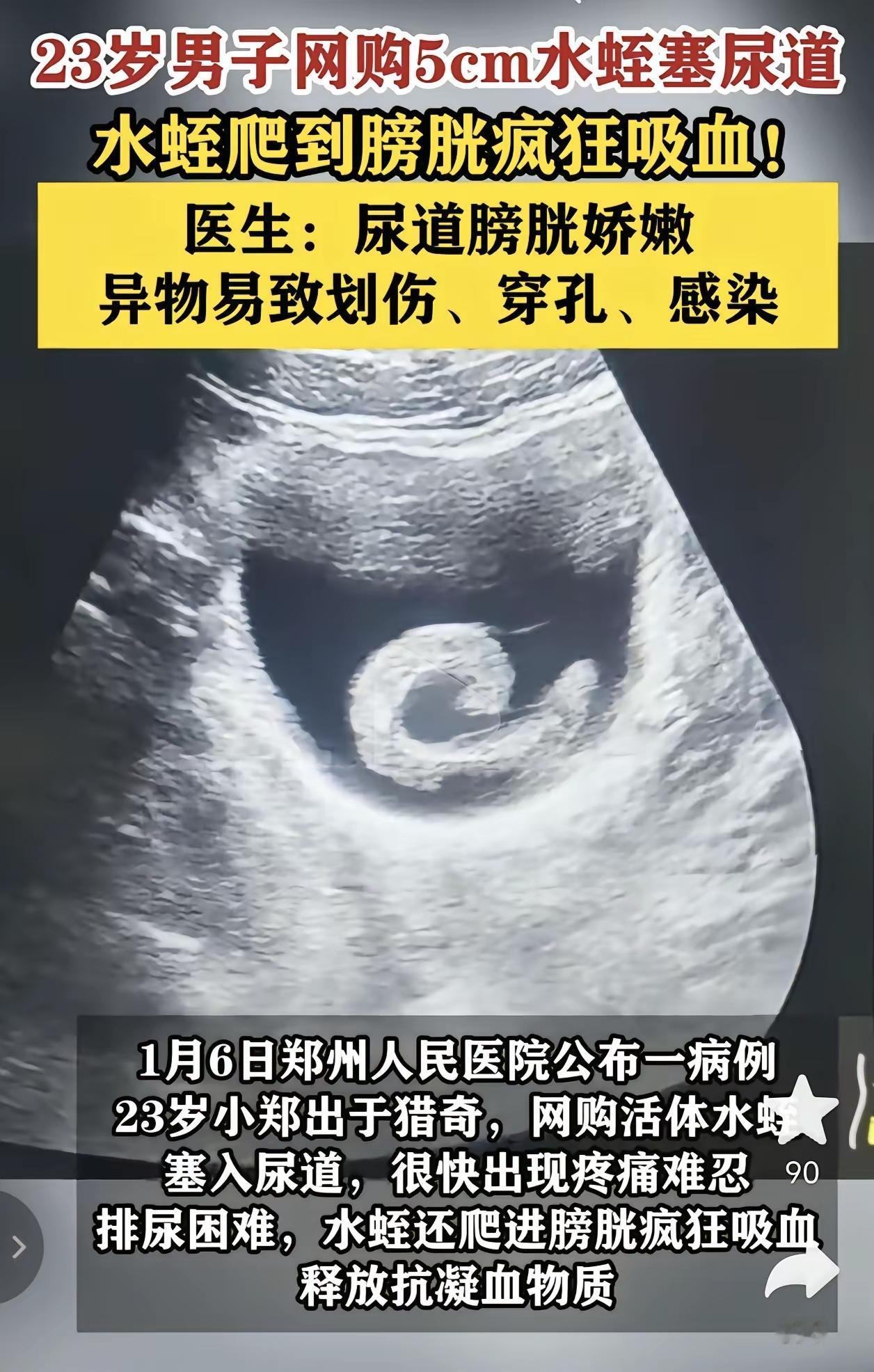 男子尿道里塞水蛭！好奇心害死猫23岁男子小郑，出于好奇和猎奇，网购5cm的水蛭塞