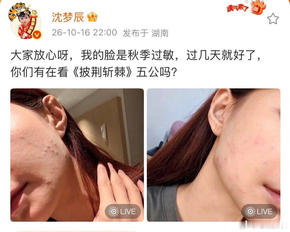 沈梦辰回应脸过敏沈梦辰回应过敏 沈梦辰回应脸过敏，秋季过敏确实烦人，希望早点恢复