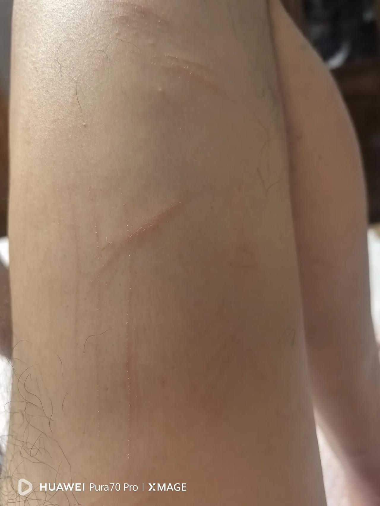 好惨！大家一定要远离家庭暴力！
谁有我惨？