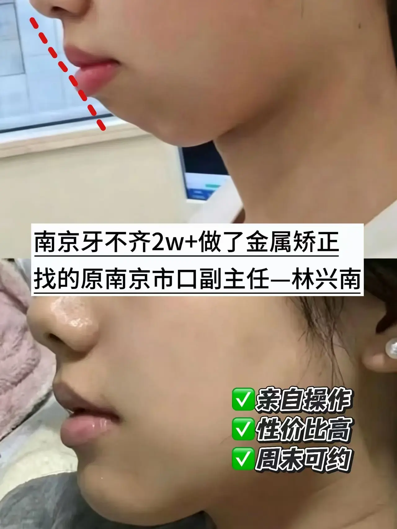 南京牙齿矫正花2w+改善嘴凸问题。南京牙齿矫正成功上岸！我是在 免费挂...