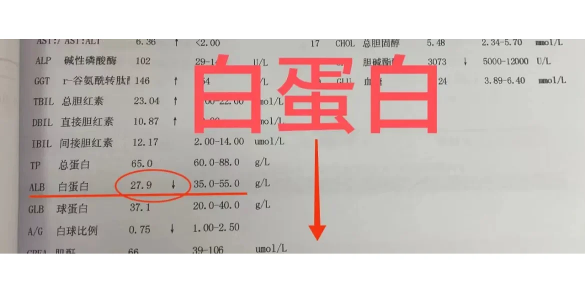 肝硬化，白蛋白<30就要输蛋白吗？ 今天接诊了一个山东潍坊的肝腹水患者...