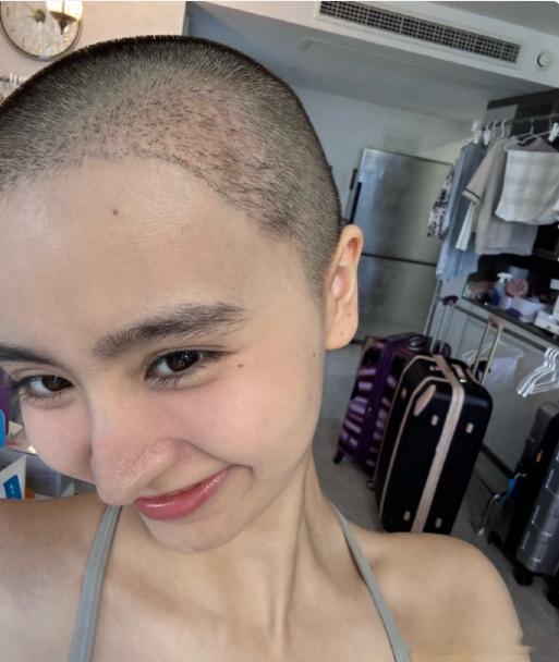 金子涵植发金子涵发际线看金子涵状态，发际线变低且自然，大家都在传她植发际线了。 