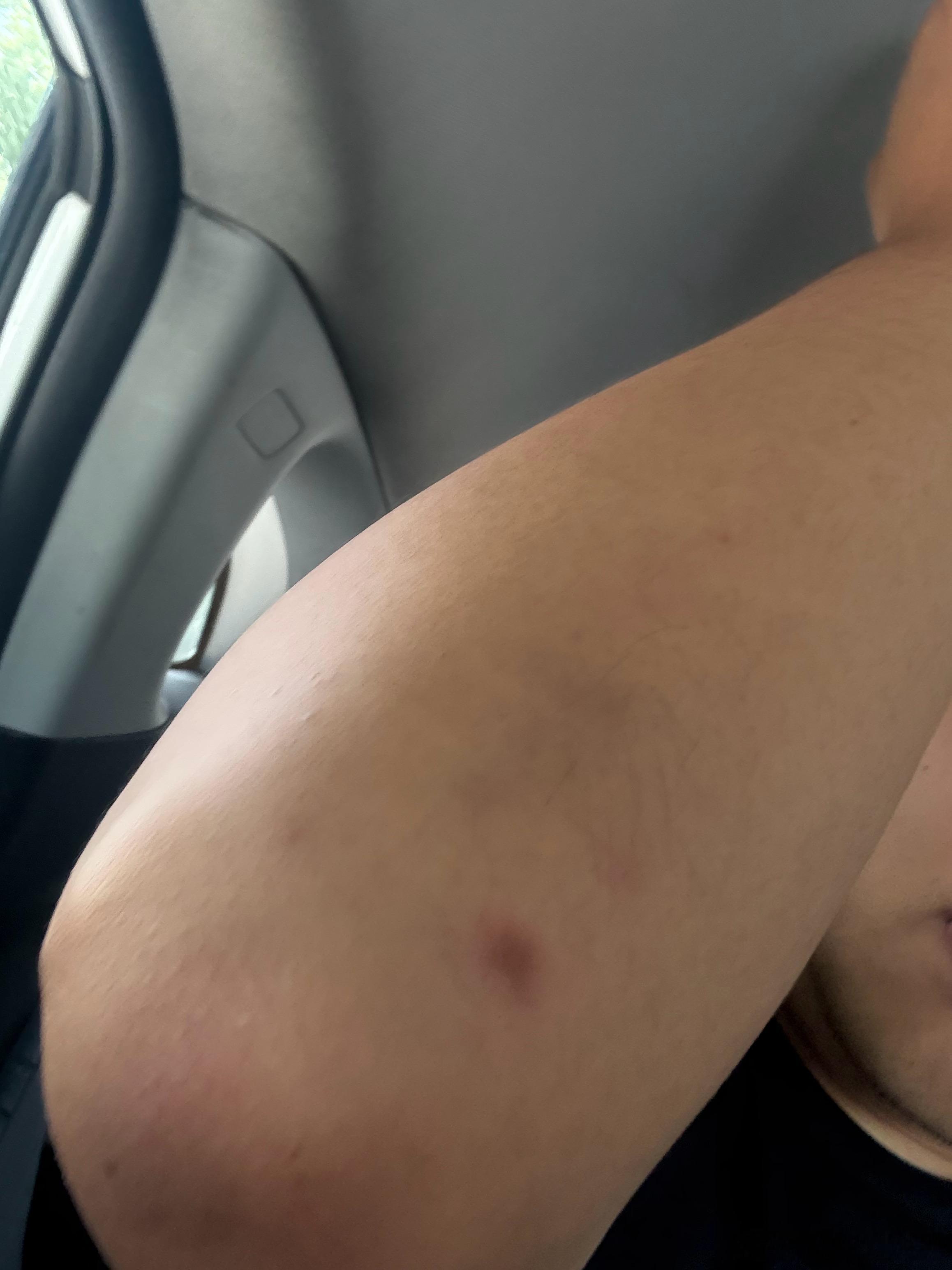 昨晚不知道谁拿烟头烫了我一下，怪刺激的…[允悲] ​​​