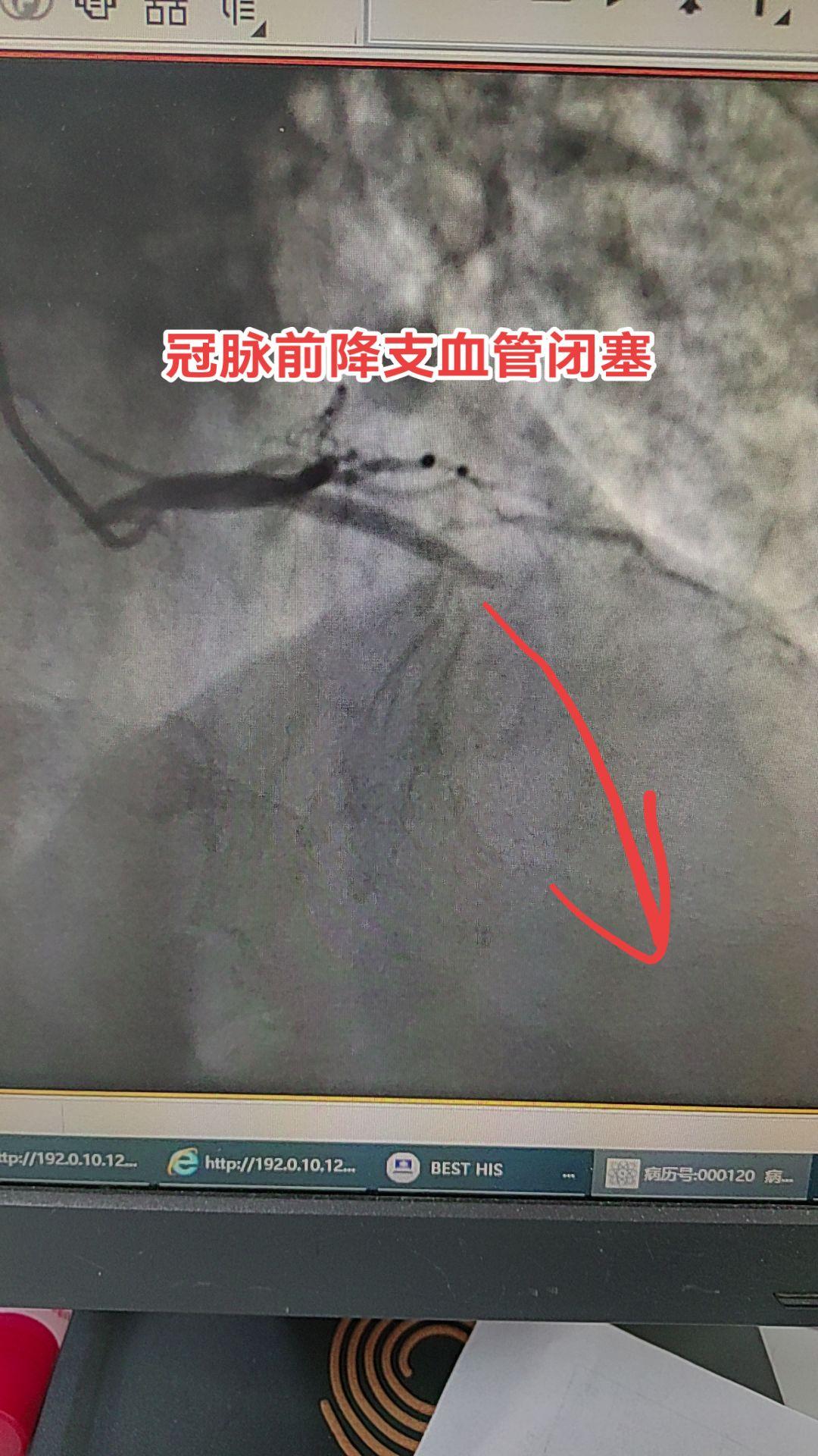 急性心梗。