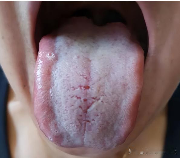看到苔白就健脾？那你健一辈子，都好不了[狗头][狗头][狗头]
这大姐30来岁，