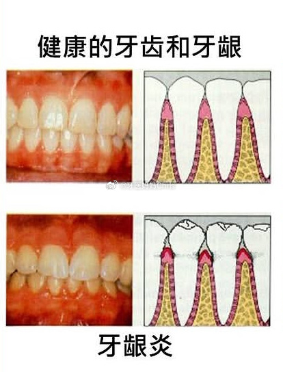 口腔健康牙髓炎 牙疼不是病，疼起来真要命“牙疼不是病，疼起来真要命”——这句俗话