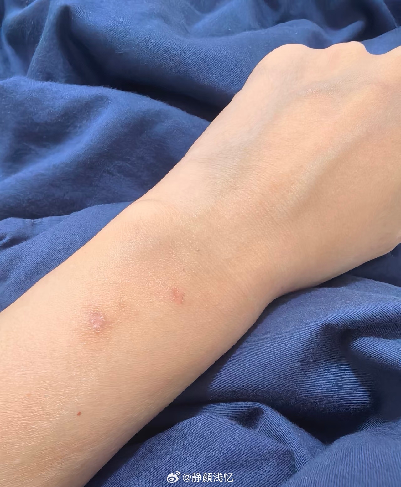 第一批戴运动手环的受害者出现了我也中招了，手腕有类似灼烧感。我一般只在晚上睡觉佩