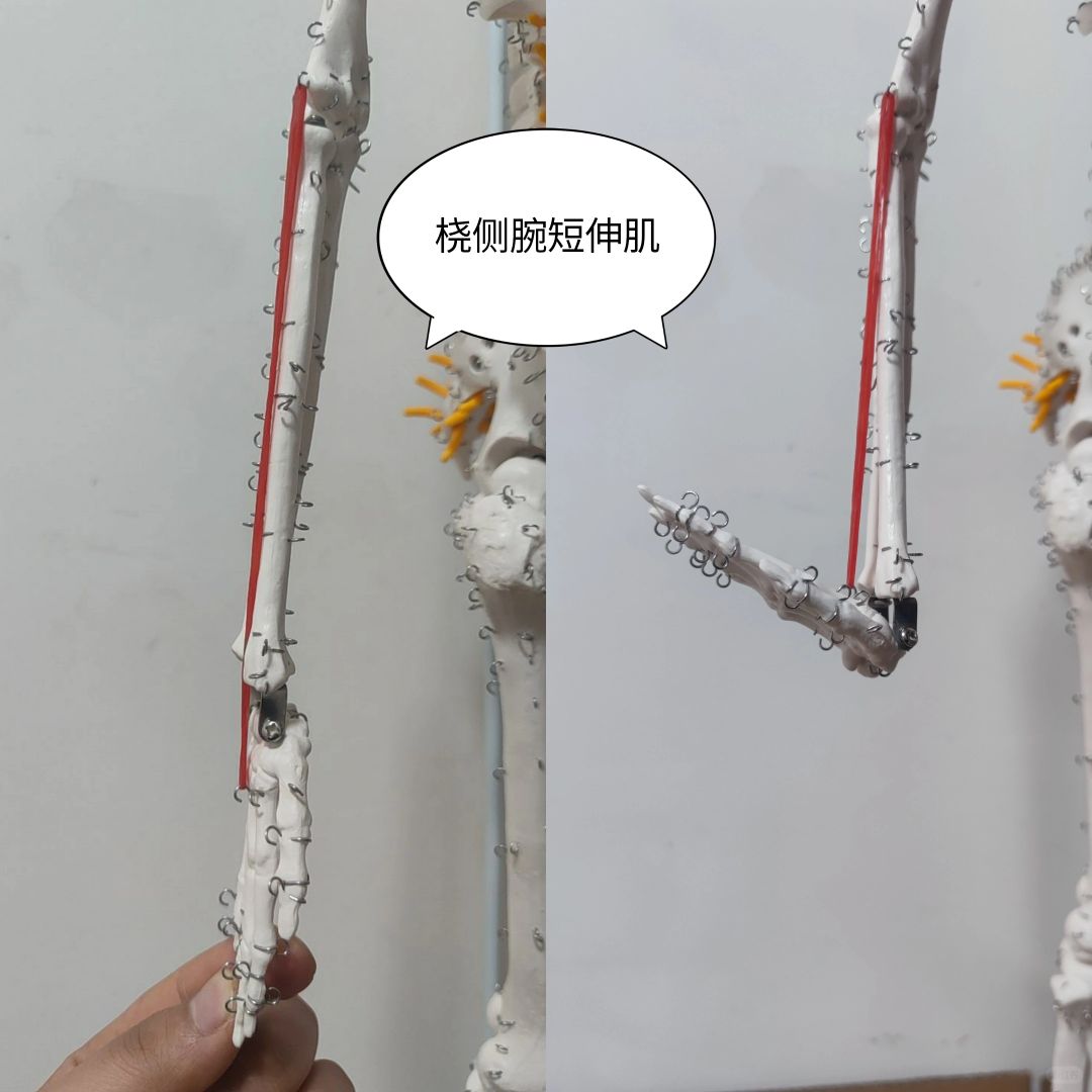 桡侧腕短伸肌