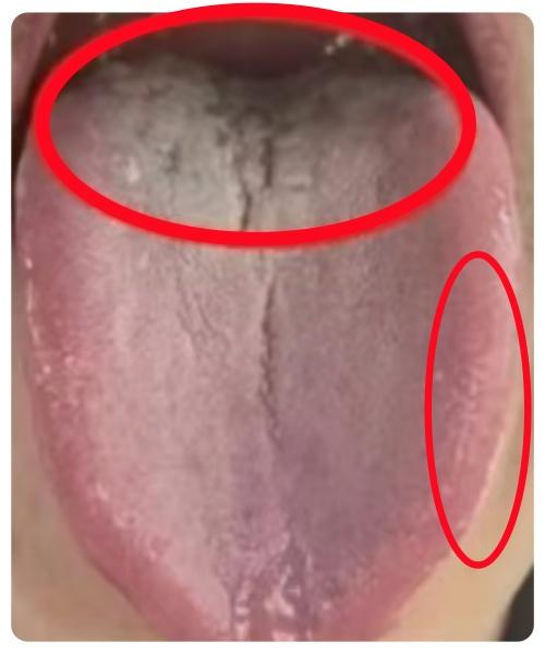 这种舌头湿气不除，宗筋难起！

这位患者30多岁，正当壮年，但是男科差劲，宗筋难