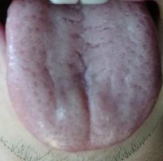 舌头为什么有裂纹？心不足舌裂，脾不足唇干，心血充盛，舌体自润

心不足舌裂，脾不