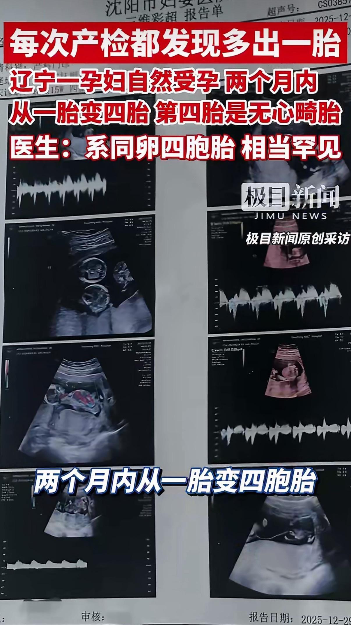 女子怀孕每次产检发现多出一胎太罕见了，同卵四胞胎！不幸的是第四胎是无心畸胎，需要