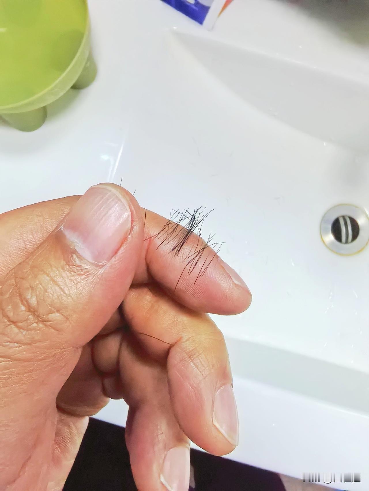 肺癌晚期，自己把头薅成斑秃了。

上次化疗换了药，现在用的多西他赛+替雷利珠单抗