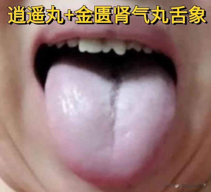 逍遥丸用的好，除了能疏肝，还能健脾、补肾、化瘀、利湿
逍遥丸+金匮肾气丸
适用：