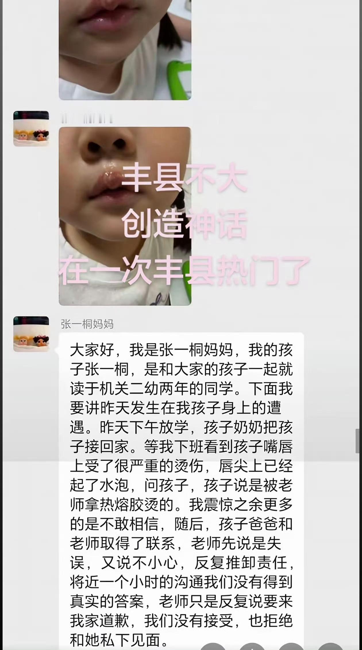女童被幼儿园老师用热熔胶烫嘴虐待烫成这样？？？怎么个不小心能烫成这样啊…… 