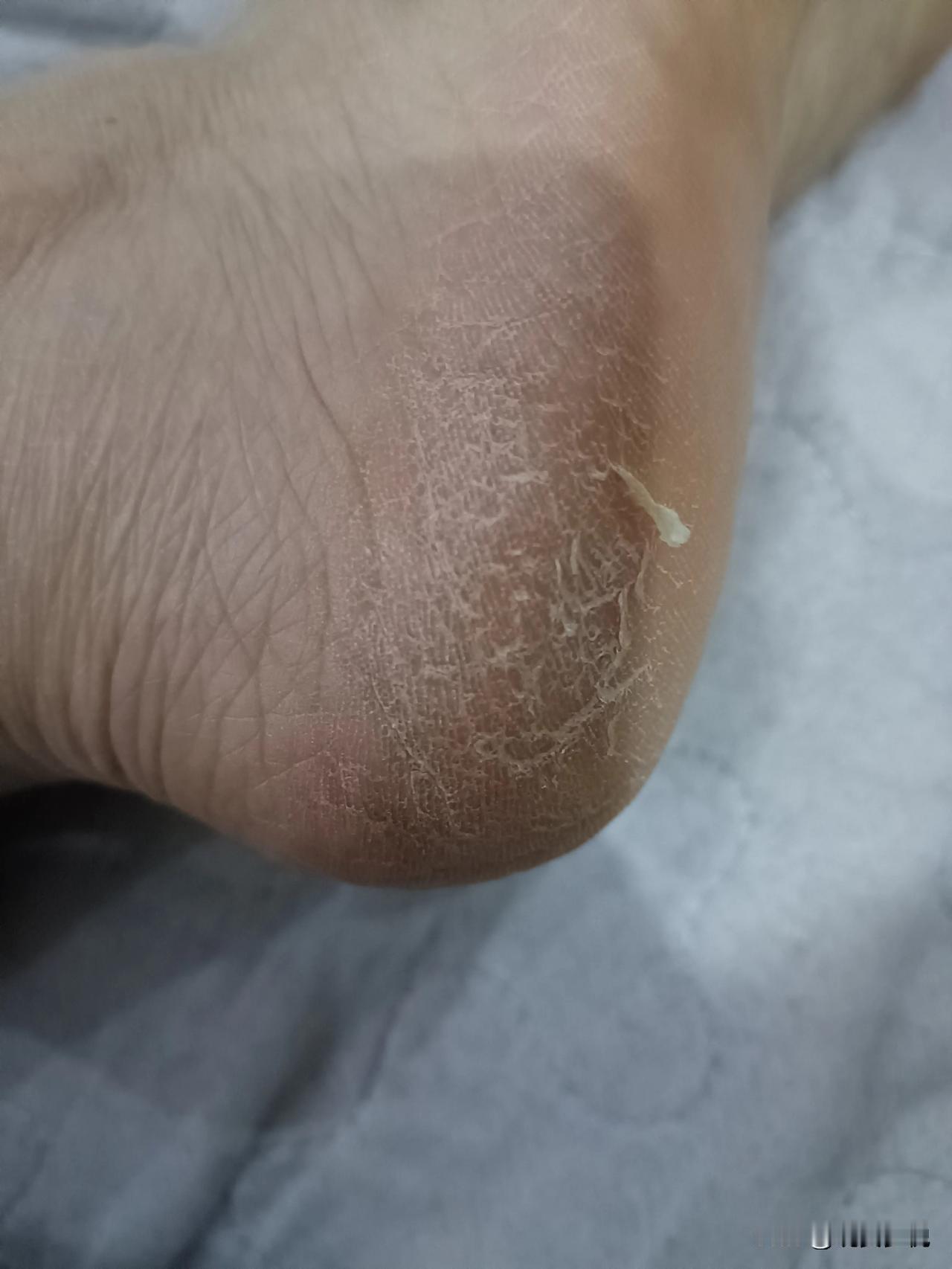 想不到吧！这竟然是一个女人的脚后跟，我还是长期在城里生活，不下地干活都这样，看着