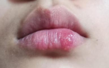 陕西一女子，嘴角长了小水泡后脑死亡！医生：这不是上火

陕西咸阳，一位年轻女子李