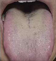 男性朋友还得看舌根，像他这种凹陷，又是黄腻的舌根，已经虚到极点了。
我们都知道，