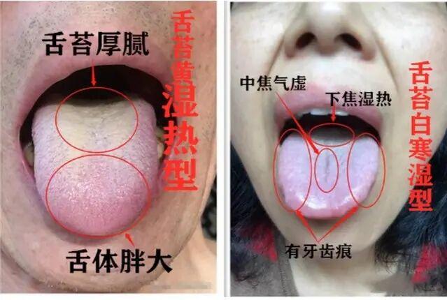 如何区分湿热与寒湿？
观察舌象：湿热者的舌质偏红，舌苔黄腻；而寒湿者舌质淡白且胖