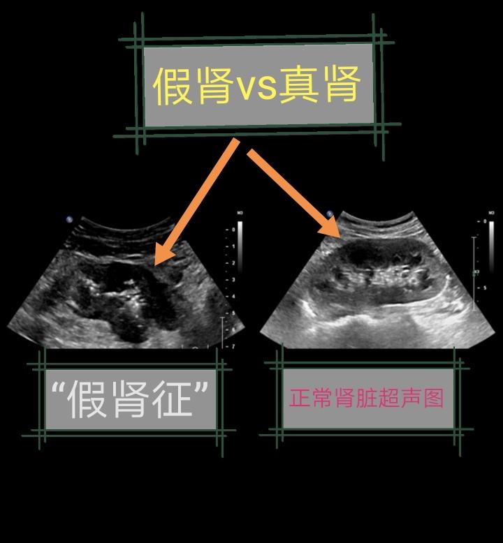 真假肾脏。一般来说，超声很难显示胃肠道肿瘤。
但是例外也有，比如“假肾征”。
“假肾征”指在胃/肠道肿瘤性病变中，胃/肠壁全周或较广泛性增厚，增厚的胃/肠壁呈低回声，狭窄胃肠腔内的气体及内容物呈高回声。整体观察，前者类似肾脏皮质回声，后者类似肾脏肾窦回声，因此称之为“假肾征”。
出现“假肾征”，通常表面胃/肠道肿瘤已经很大了。