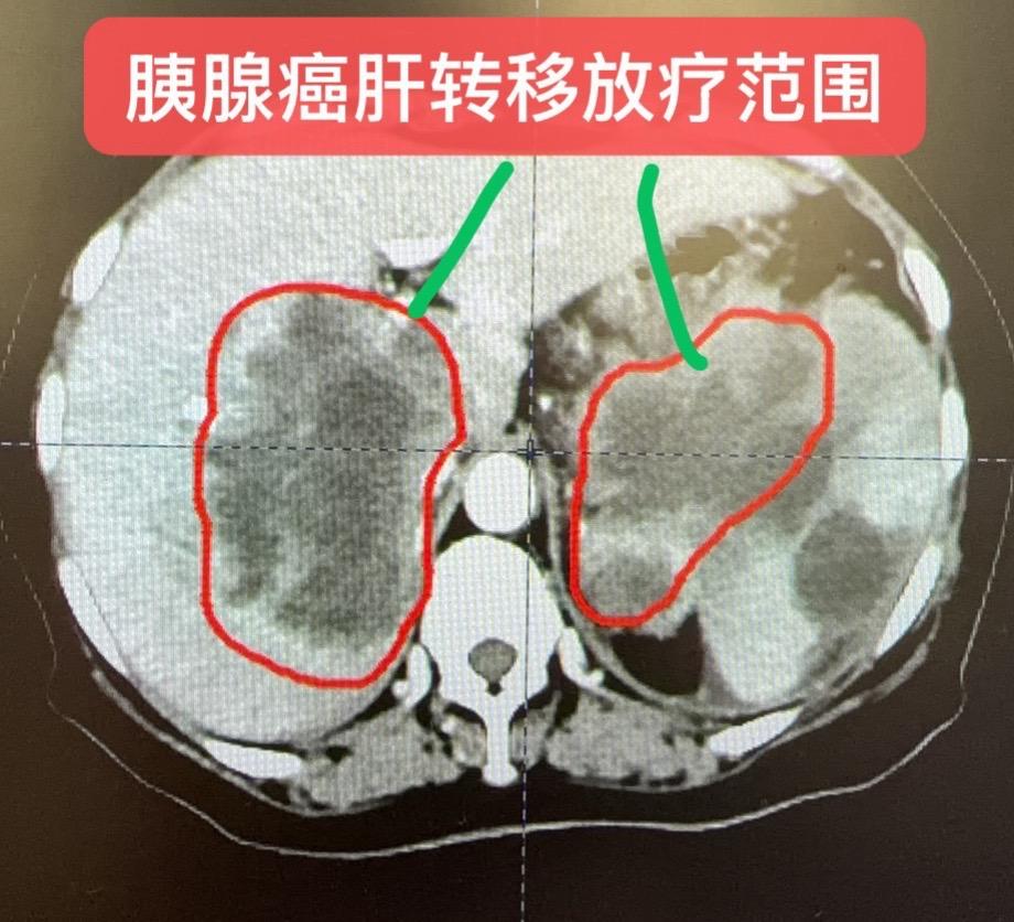 胰腺癌肝转移的曲折治疗个案分享。患者女，50岁，于2024年10月确诊...