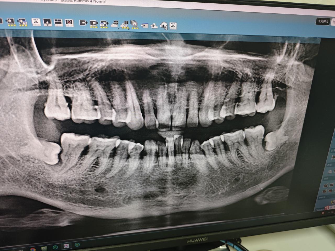 今天去医院看牙，我明明只有一颗牙痛，医生却说我5颗牙都有问题，都要拔掉。有没有人