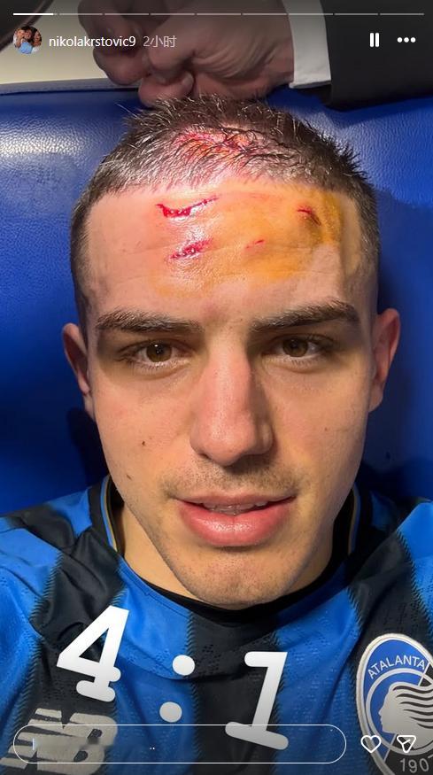 克尔斯托维奇今天确实是英雄，不是谁都有勇气用头去跟鞋钉抢1/2球的… 